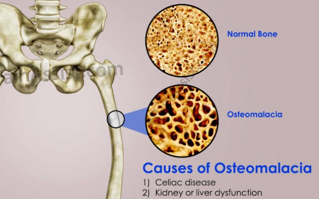 vitamin D deficiency osteomalacia