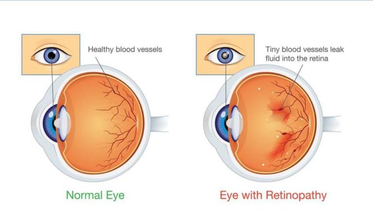 Myths and truths about relation between Diabetes and eye sight.