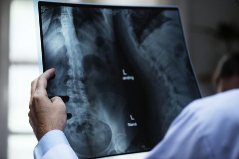 Arthritis – Everything That You Need to Know