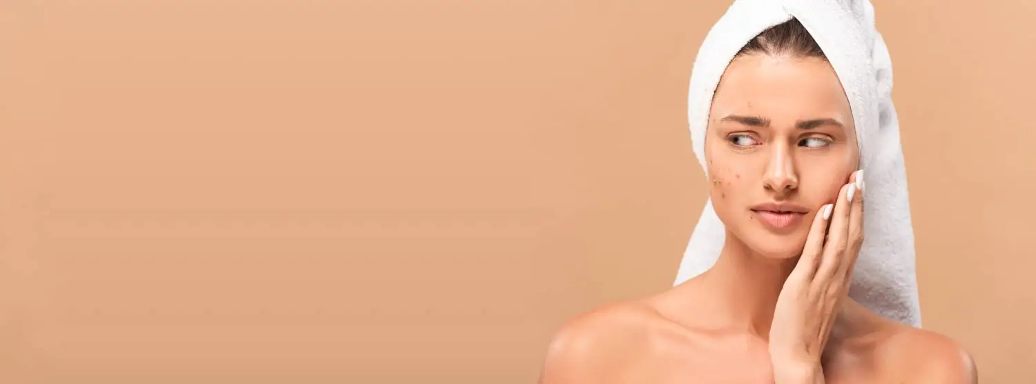 Acne & Excess Androgen