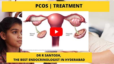 PCOS | Polycystic Ovarian Syndrome | Treatments | Dr R Santosh | Best Endocrinologist in Hyderabad}